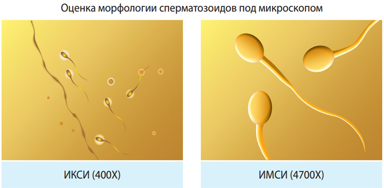 Метод ІМСІ (IMSI). Суть методу. Показання. Результати.